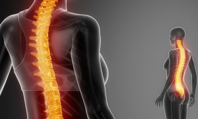 kyphosis treatment in dwarka sector 12