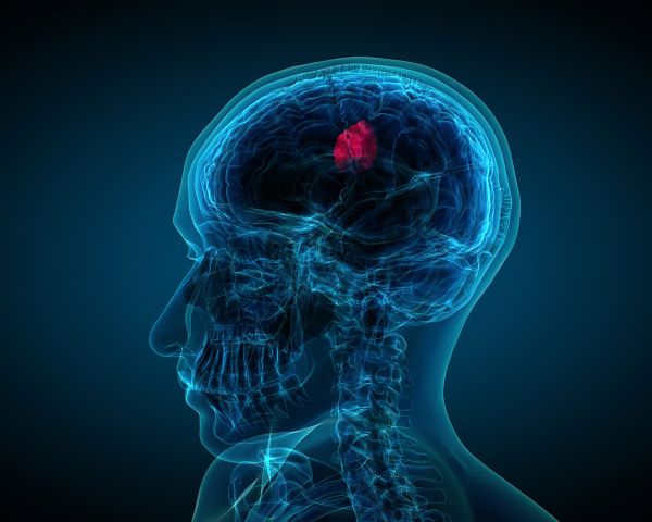 brain tumor test in delhi