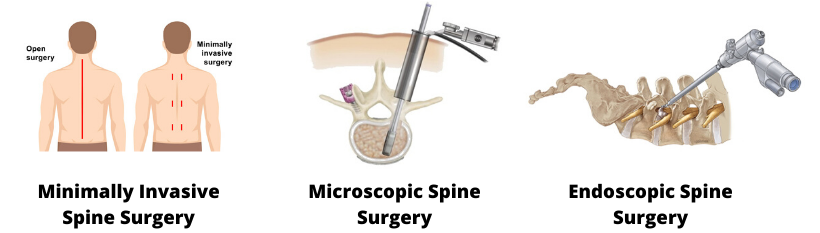 spine endoscopic surgery cost