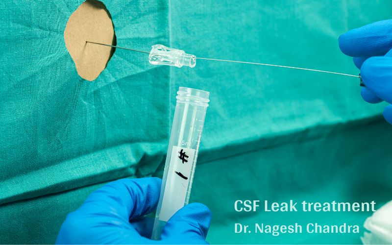 CSF fluid leak specialist in Dwarka, Delhi