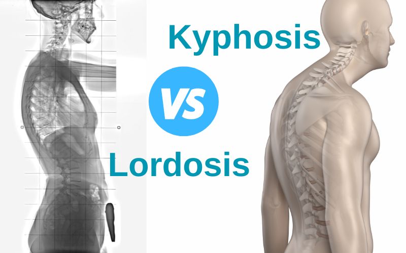 Kyphosis and lordosis