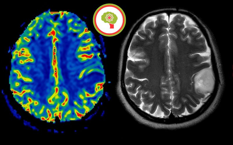 Brain Tumor Symptoms