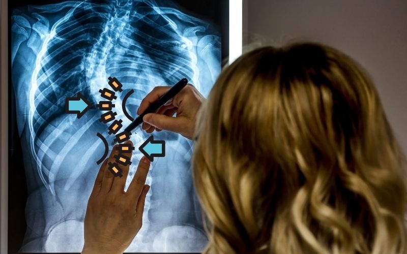 How Scoliosis Affects Your Lungs and Heart Over Time
