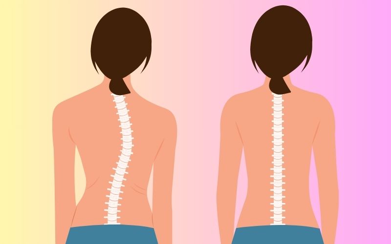 Scoliosis specialist in Delhi