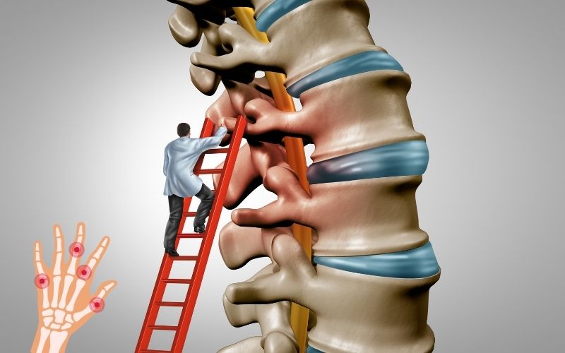 Hirayama disease treatment in delhi