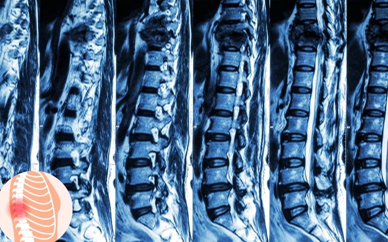 Spinal Fracture and their types with treatment in Delhi