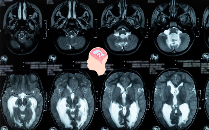 Hydrocephalus treatment without surgery in delhi