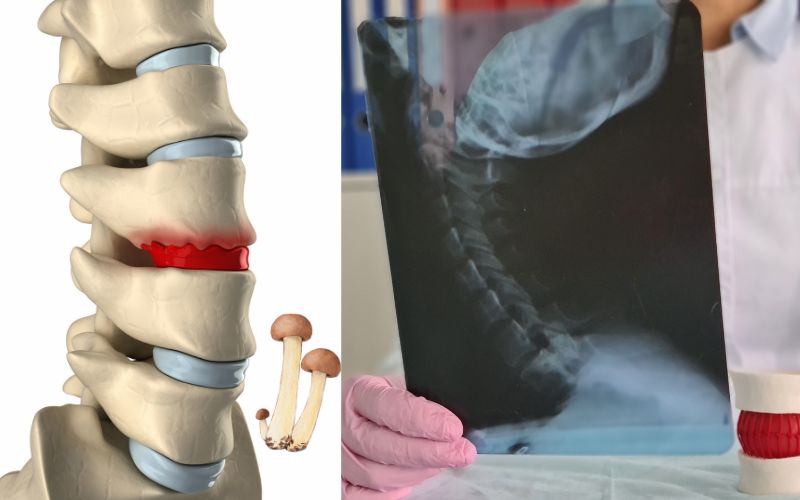 Causes of osteophytes and best treatment in Delhi | Neurosurgeon in Delhi