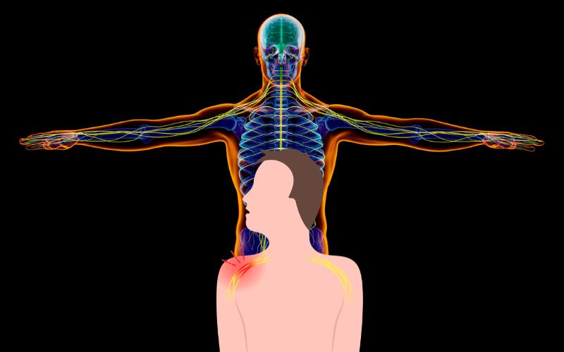 brachial plexus injury treatment in Delhi dwarka