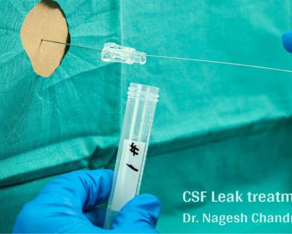 CSF fluid leak specialist in Dwarka, Delhi
