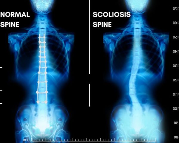 SCOLIOSIS IN SPINE